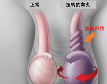 睾丸扭转能自己恢复吗？睾丸扭转怎么办