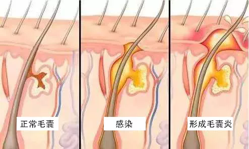 男女私处常见痘痘大详解