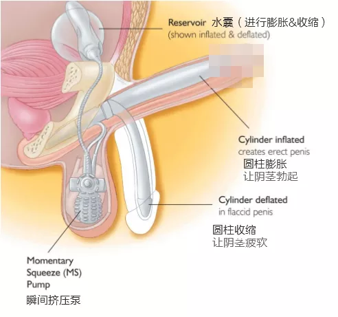 阴茎假体手术，竟然有30万人装了假丁丁